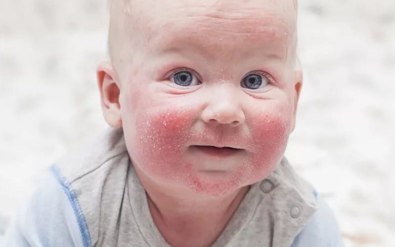 Контактный дерматит у ребенка фото